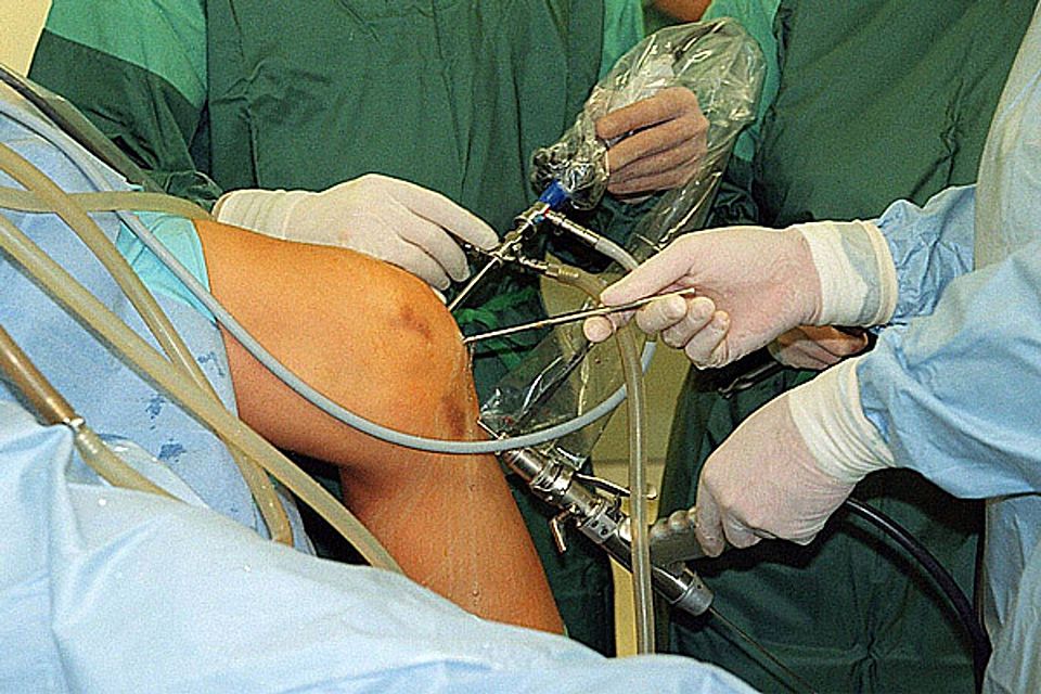 Bei einer Operation wird das Kreuzband durch eine körpereigene Sehne, die mehrfach gedoppelt wird, ersetzt. Das am besten geeignete Transplantat hierzu ist eine Sehne aus dem hinteren Oberschenkel, sagt Dr. Schneider.  Foto: imago