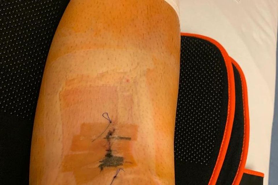 Daniel Behrs Knie kurz nach der Operation. Bis zum Comeback braucht es viel Geduld.